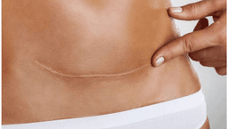 Image for C- section/Tummy tuck/Facelift Scar Release Therapy