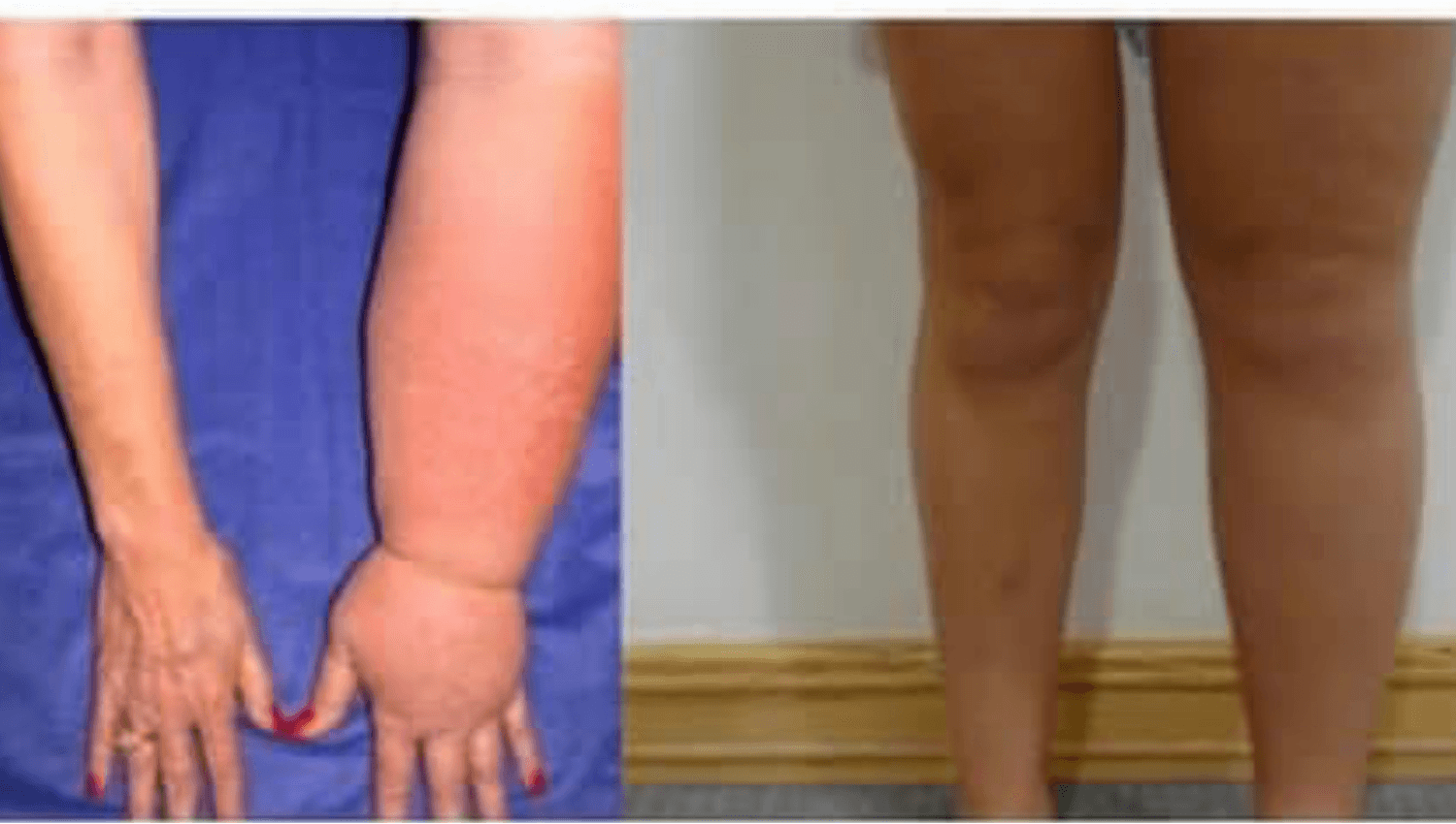 Image for Lymphedema and Lipedema management