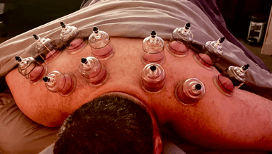 Image for Cupping therapy or sports cupping